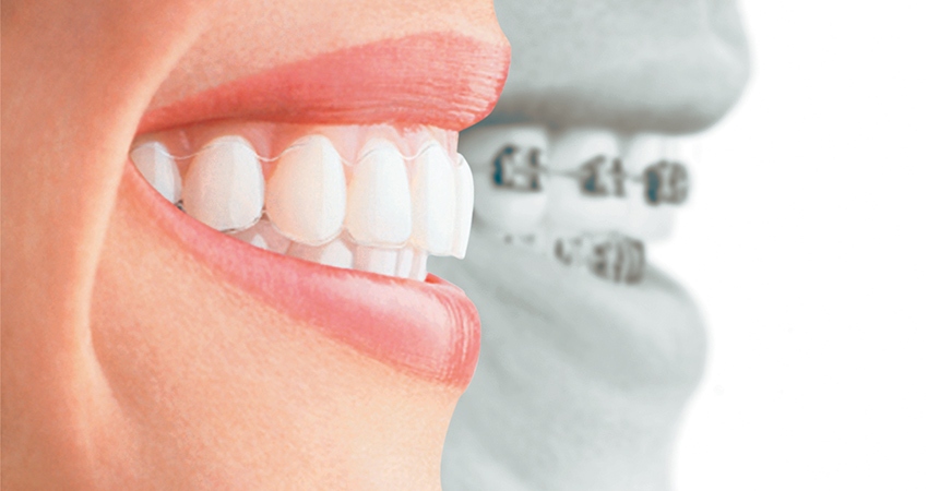 Invisalign-1